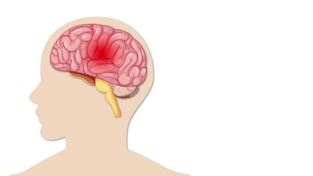 Medical animation showing ischemic stroke caused by blood clot in brain artery.