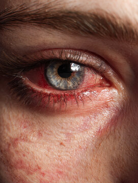 Detailed view of a human eye with visible redness and irritation showcasing skin texture and natural eyelashes in high-resolution photography