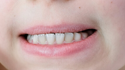 Obraz premium Mesial occlusion. Close-up childs mouth with clean white molars teeth with gap and healthy gums. Ten year age caucasian kid with closely spaced teeth. Upper teeth behind lower. Plaque on enamel.
