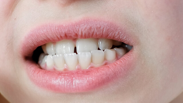 Mesial occlusion. Close-up childs mouth with clean white molars teeth with gap and healthy gums. Ten year age caucasian kid with closely spaced teeth. Upper teeth behind lower. Plaque on enamel.