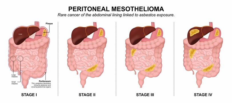 Peritoneal Mesothelioma abdomen flashcard illustration