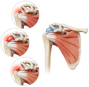 Rotator Cuff Disease . Medical Illustration of Tear, Bursitis, and Tendinopathy.
