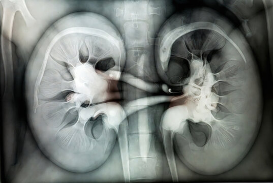 Kidney X-ray: Two kidneys and ureters are visible, indicating a radiographic examination of the urinary system.