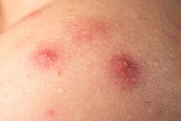 Fototapeta premium Macro shot of skin irritation with acne. Close up epidermis with inflamed follicles and acne. Skin rash texture with acne. Detailed skin with acne.