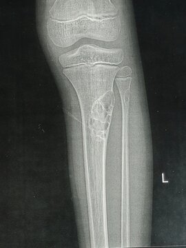 A Plain X-ray showing a visible lesion in the upper part of the left Tibia bone with a well-defined, multi-loculated (bubbly) lytic lesion in the proximal tibial shaft for differential diagnosis