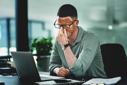 Eye strain, glasses or man in workplace with laptop, headache or brain fog in task management. Screen fatigue, tech and employee with vitiligo, migraine and vision discomfort in deadline issue.