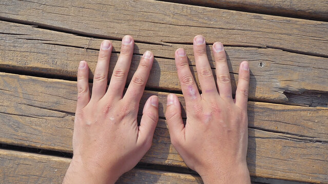 Hands with vitiligo skin condition on wooden surface showing depigmentation pattern and natural texture closeup