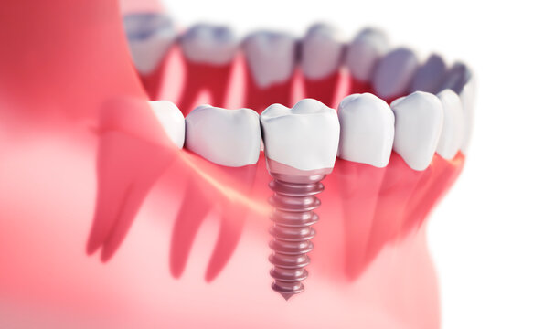 Close-up of a dental implant with crown in the lower jaw against a white background - 3D illustration