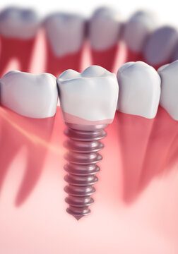 Close-up of a dental implant with crown in the lower jaw against a white background - 3D illustration
