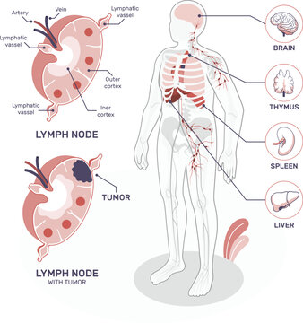 Lymphatic system anatomy and lymph node structure with tumor illustration