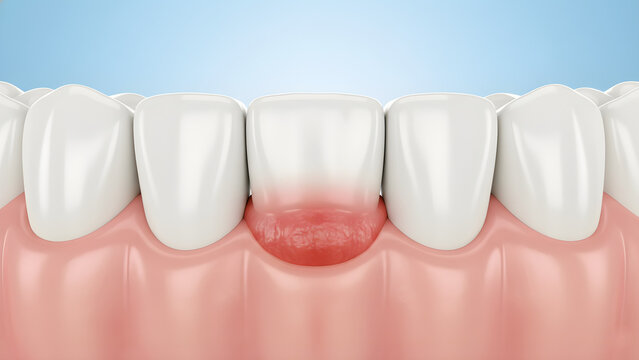 3D illustration of a row of white teeth with red, inflamed gingivitis or periodontal disease affecting the gum tissue

