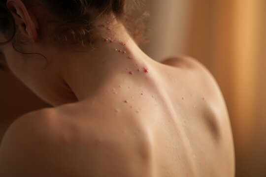 Close up of red bumps on a person's neck and upper back skin rash