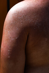 Naklejka premium Close Up Dermatology of Peeling Sunburned Skin on Shoulder Body Part