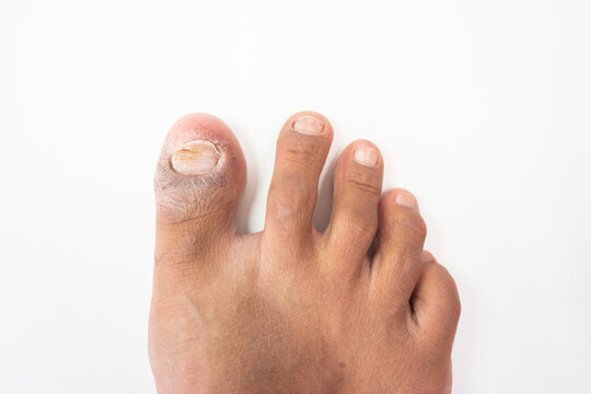 Foot Close Up Showing Damaged Toenail Infection