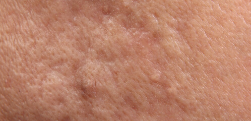 Fototapeta premium Blackheads acne. Macro close up image of facial skin and nose. showing visible pores blackheads acne marks and skin texture. Ideal for skincare dermatology cosmetic treatment and skin health concepts
