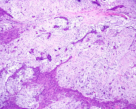 Parotid gland. Pleomorphic adenoma