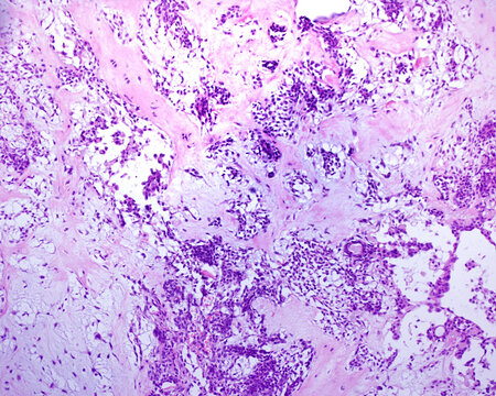 Parotid gland. Pleomorphic adenoma