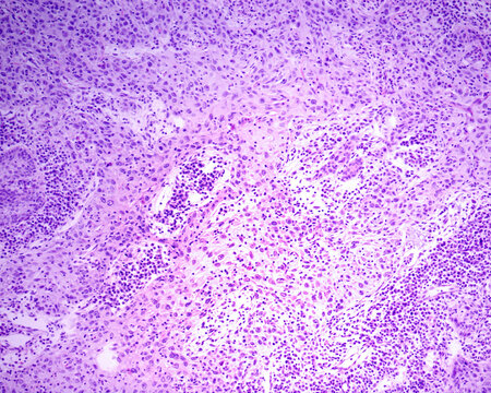 Human skin. Squamous-cell carcinoma