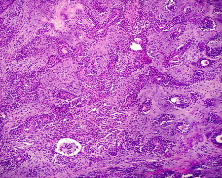 Parotid gland. Pleomorphic adenoma