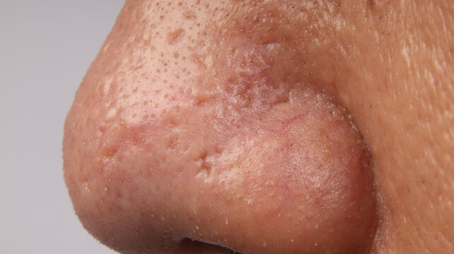 a human nose showing severe skin problems