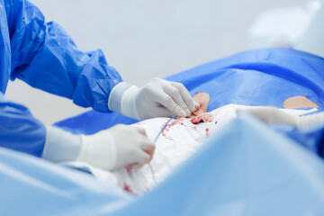 Naklejka premium Cardiac catheterization procedure closeup with surgeons in sterile blue drapes for medical publication