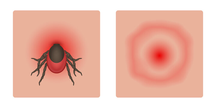 Tick Bite with Erythema and Bite Mark. Signs of Lyme Disease. Vector Illustration