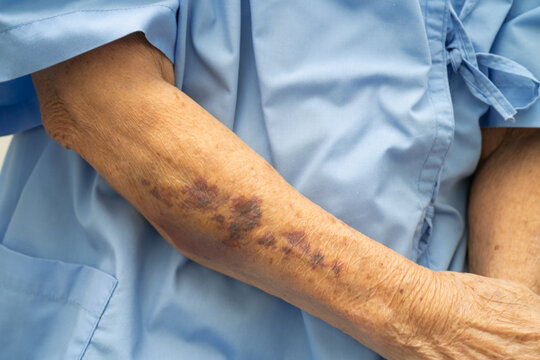 Ecchymosis, elderly bleeding on her arm after taking aspirin.