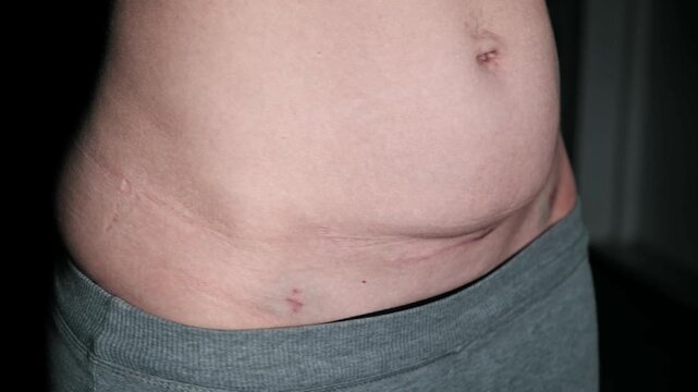 Fresh medical scars on female abdomen after laparoscopic surgery. Stretch marks on light caucasian skin after cesarean section on dark background. Body Lymphatic edema. Maternity concept. Front view.
