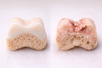 Fototapeta premium Healthy Cartilage vs Osteochondral Defect Specimen Comparison
