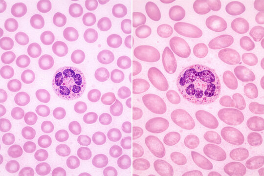 Normal Blood Smear vs Megaloblastic Anemia Comparison