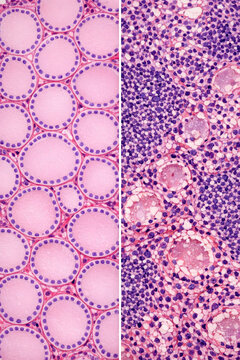 Normal Thyroid Tissue vs Hashimoto Thyroiditis Comparison