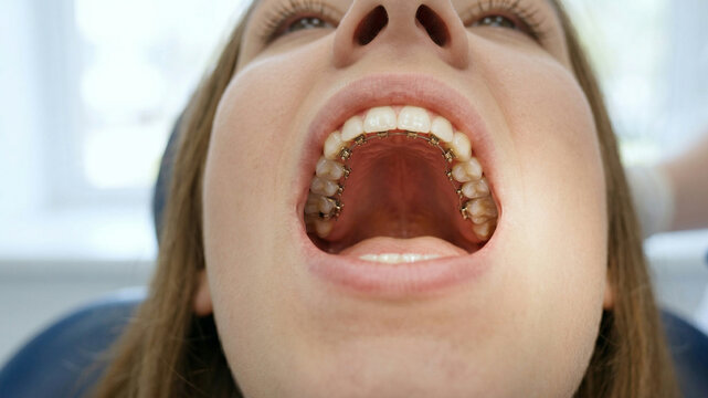 Internal Lingual Braces on Upper Teeth of a Young Woman Close-up