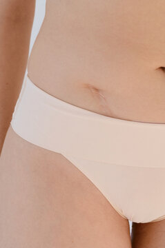 woman's belly with a scar