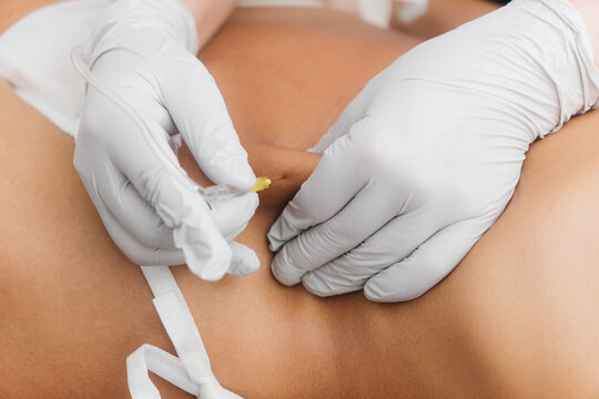 Aesthetic injection application in the abdominal area