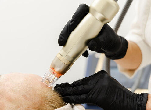Gloved Hand Applying RF Device to Forehead Close-Up