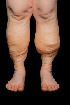 Detailed medical photograph showing severe swelling and skin folding in a patient's lower legs and feet, likely representing conditions such as lymphedema or lipedema, isolated on a black background.