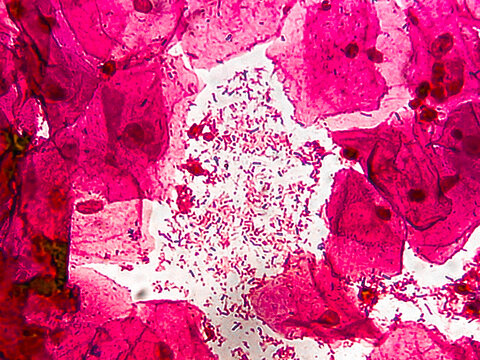 HVS for gram stain. Gram positive bacilli seen. Suggestive of lactobacilli.