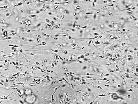 Sperm analysis on microscopic examination, Normozoospermia, normal semen analysis.
