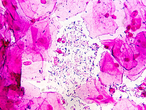 HVS for gram stain. Gram positive bacilli seen. Suggestive of lactobacilli.