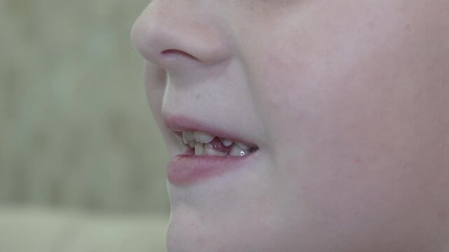 baby teeth fall out in child, baby tooth is wobbling in child, Loss of first baby tooth, pediatric dentistry