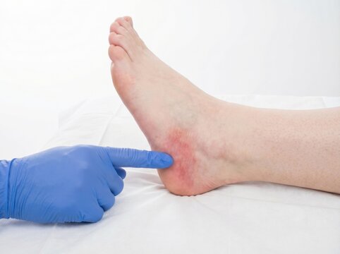 Medical professional pointing at pressure injury on heel