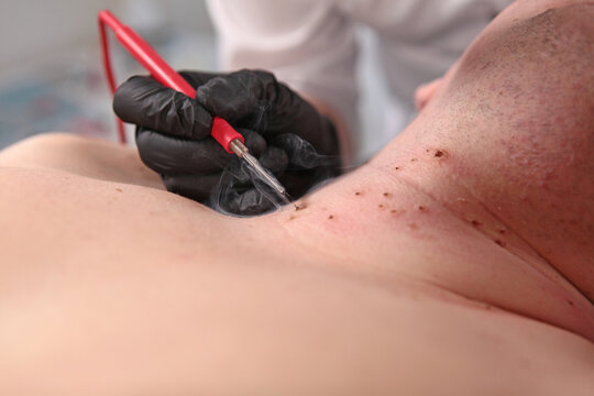 Man undergoing procedure to remove warts and papillomas. Laser removal of papillomas on skin. Laser cauterization of benign growths on skin. Prevention of melanoma. Aesthetic medicine.
