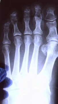 Doctor hands with blue medical x ray scan of feet and toes with Hallux Valgus deformity close up, vertical video, vertical