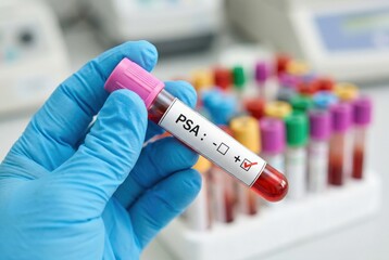 Fototapeta premium Hand in a blue medical glove holding a positive blood sample test tube for PSA