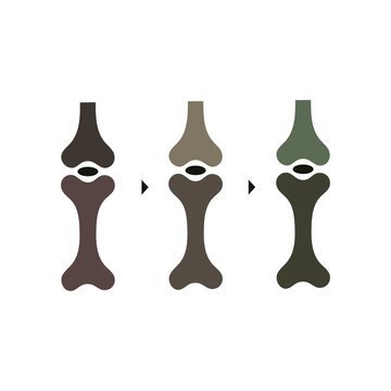 Stages of a knee joint replacement prosthetic fitting process