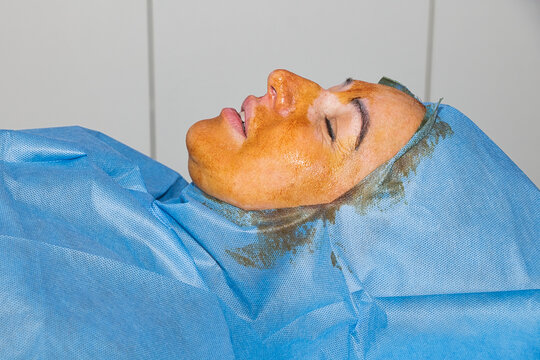 Antiseptic treatment before the thread facelift procedure.