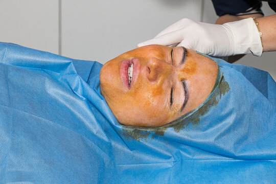Antiseptic treatment before the thread facelift procedure.