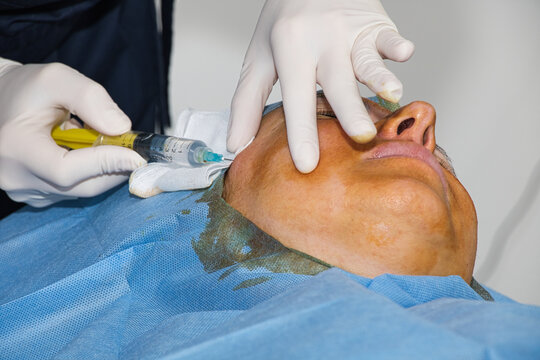 Anesthesia administered before a facelift using absorbable threads. Close-up.