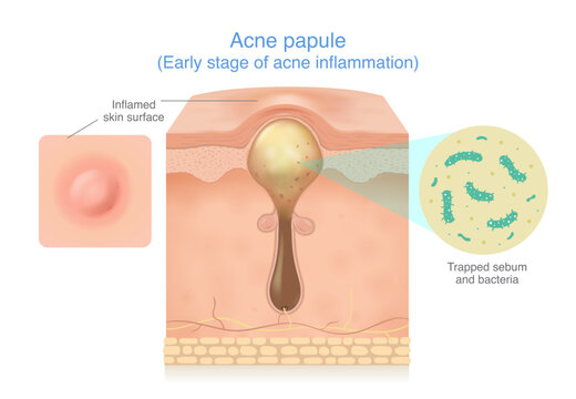 Skin layer anatomy of papule acne at 2 side have close up of inflamed skin surface small red and clogged pore by trapped sebum and bacteria. Medical diagram about early stage acne so swollen bump.