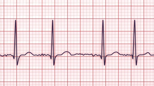 Atrial fibrillation ECG, 3D illustration, electrocardiogram tracing showing irregularly irregular rhythm without distinct P waves.